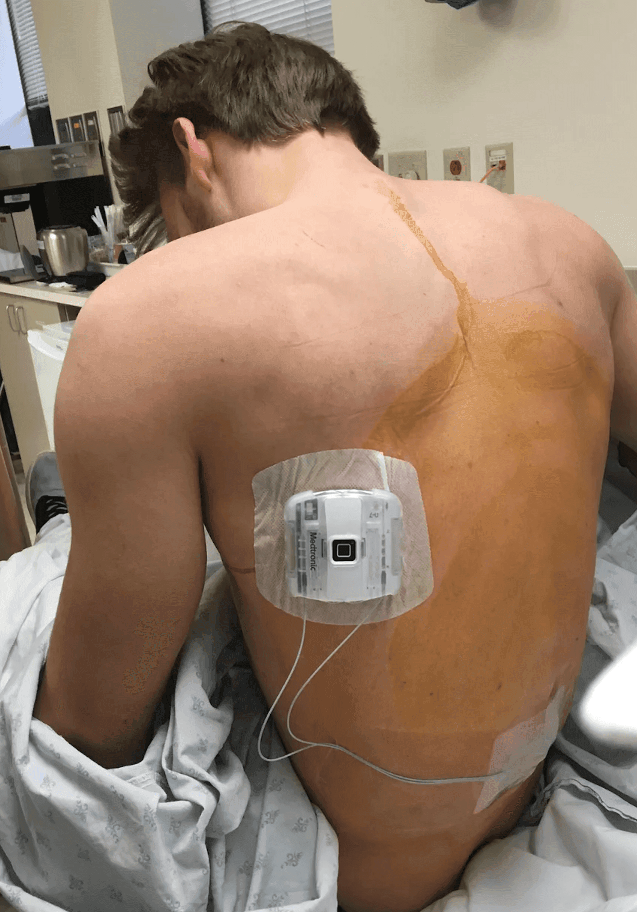 Patient's back with Spinal Cord Stimulator post-surgery, showing device and surgical marks.