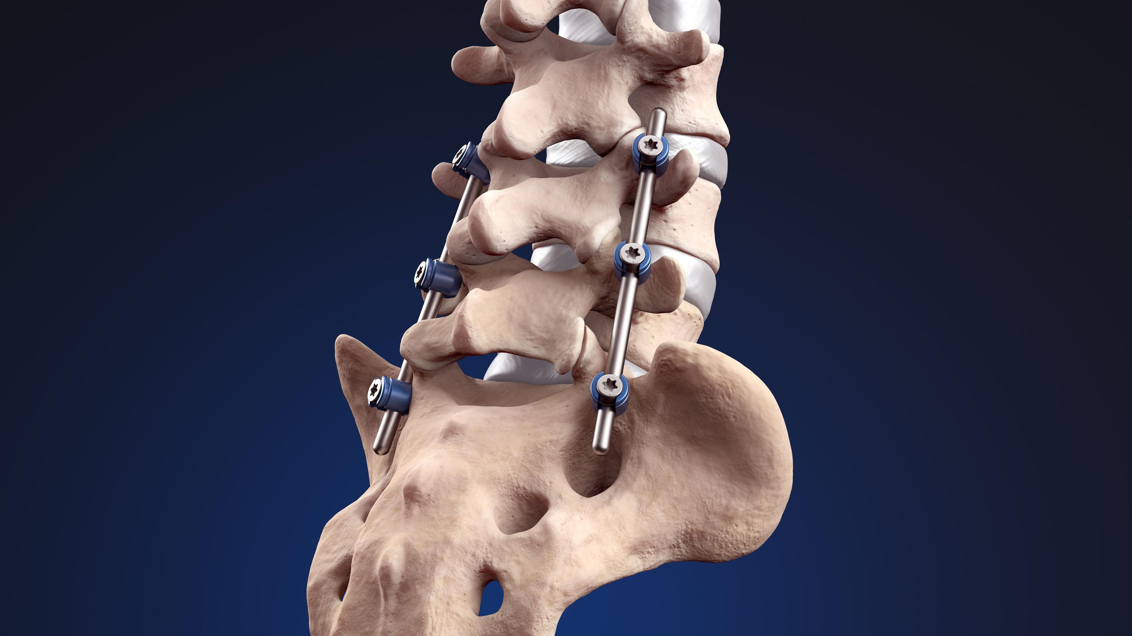 Is Spinal Fusion the Only Option? What Your Surgeon Might Not Tell You