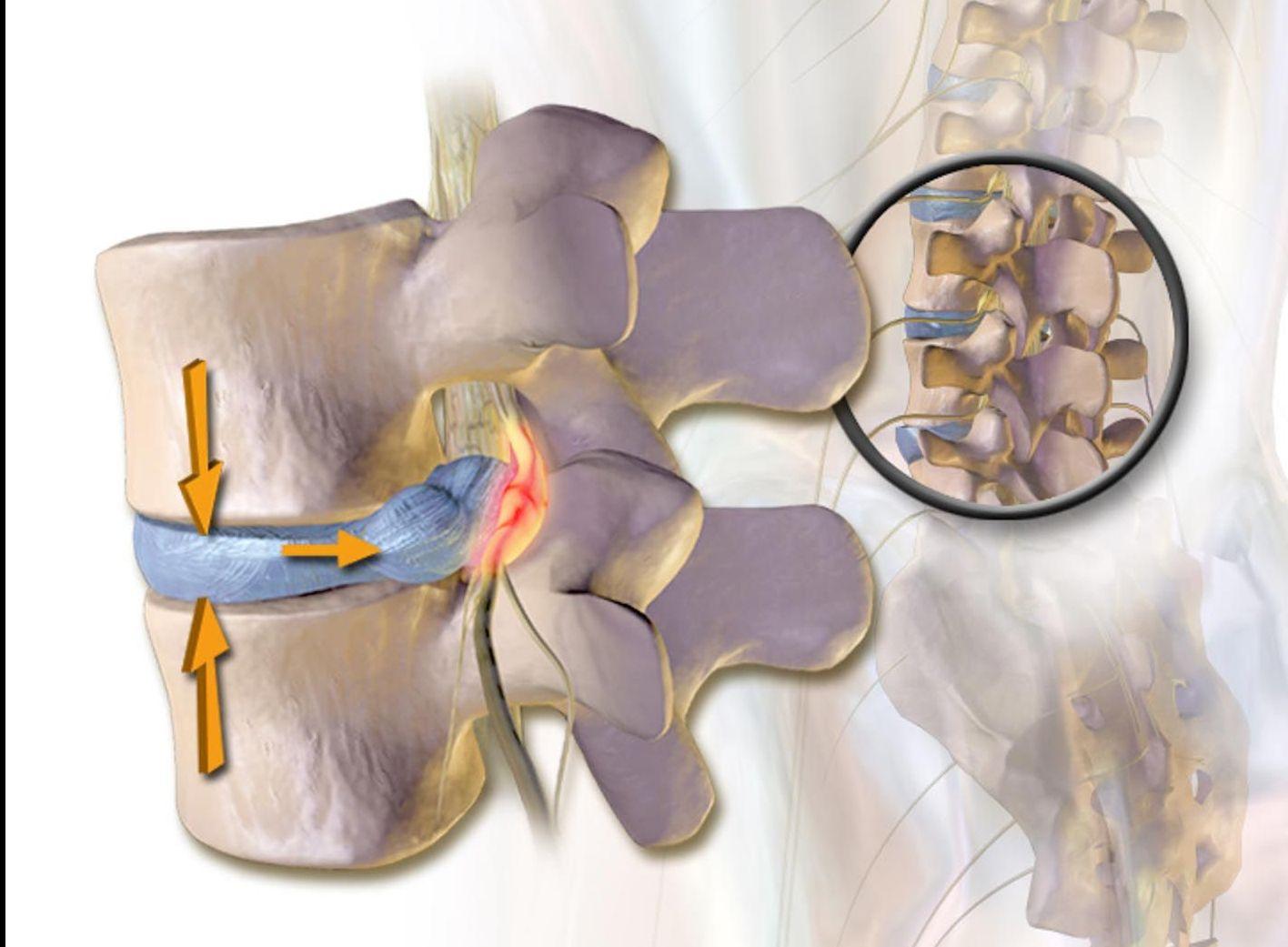 close-up diagram of a herniated disc
