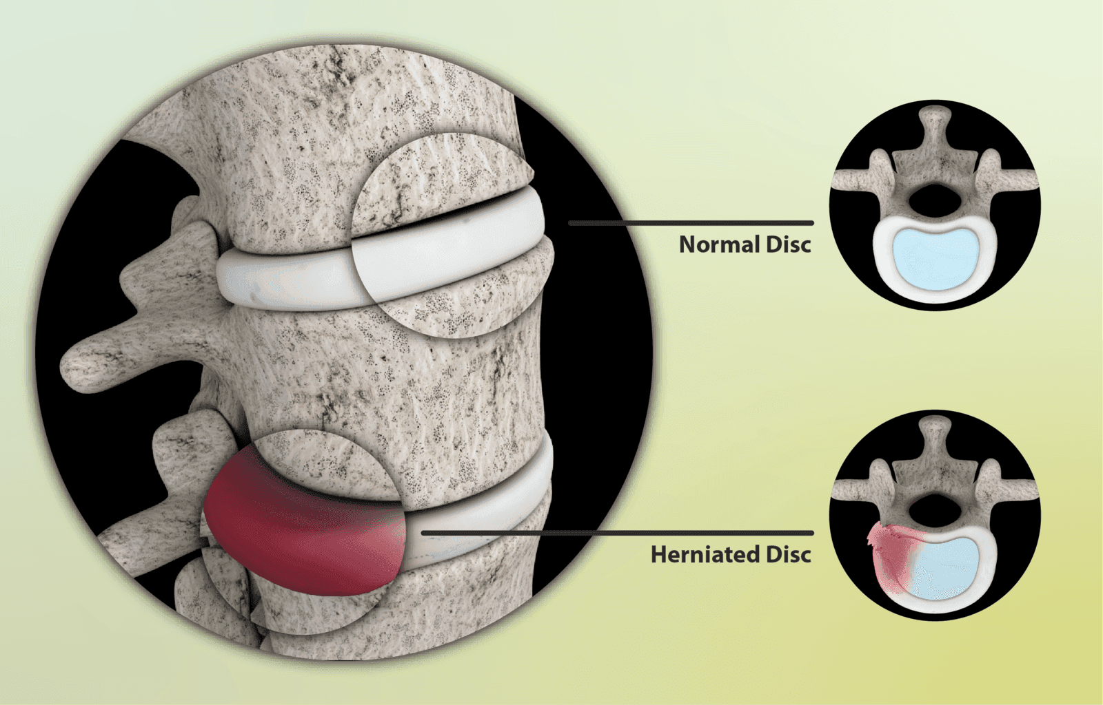 An animation showing both normal and the herniated disc.