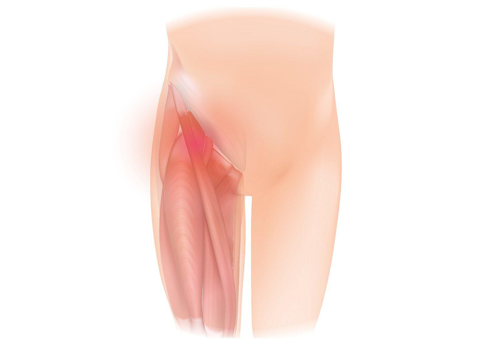 Herniated Disc Groin Pain: Causes & Relief