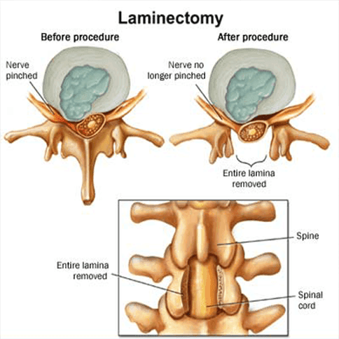 Laminectomy involves invasively removing the lamina to prevent the nerve being pinched.