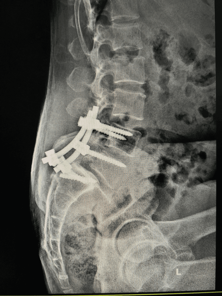 Example of metal hardware placed in body during spinal fusion