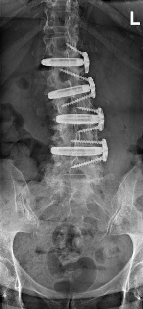 X-ray of a completed XLIF surgery with metal rods screws, and cages
