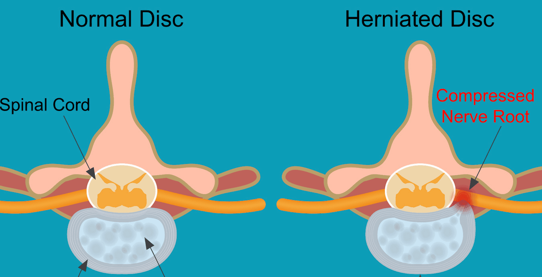 A picture showcasing a comparison between a normal disc and a herniated disc.