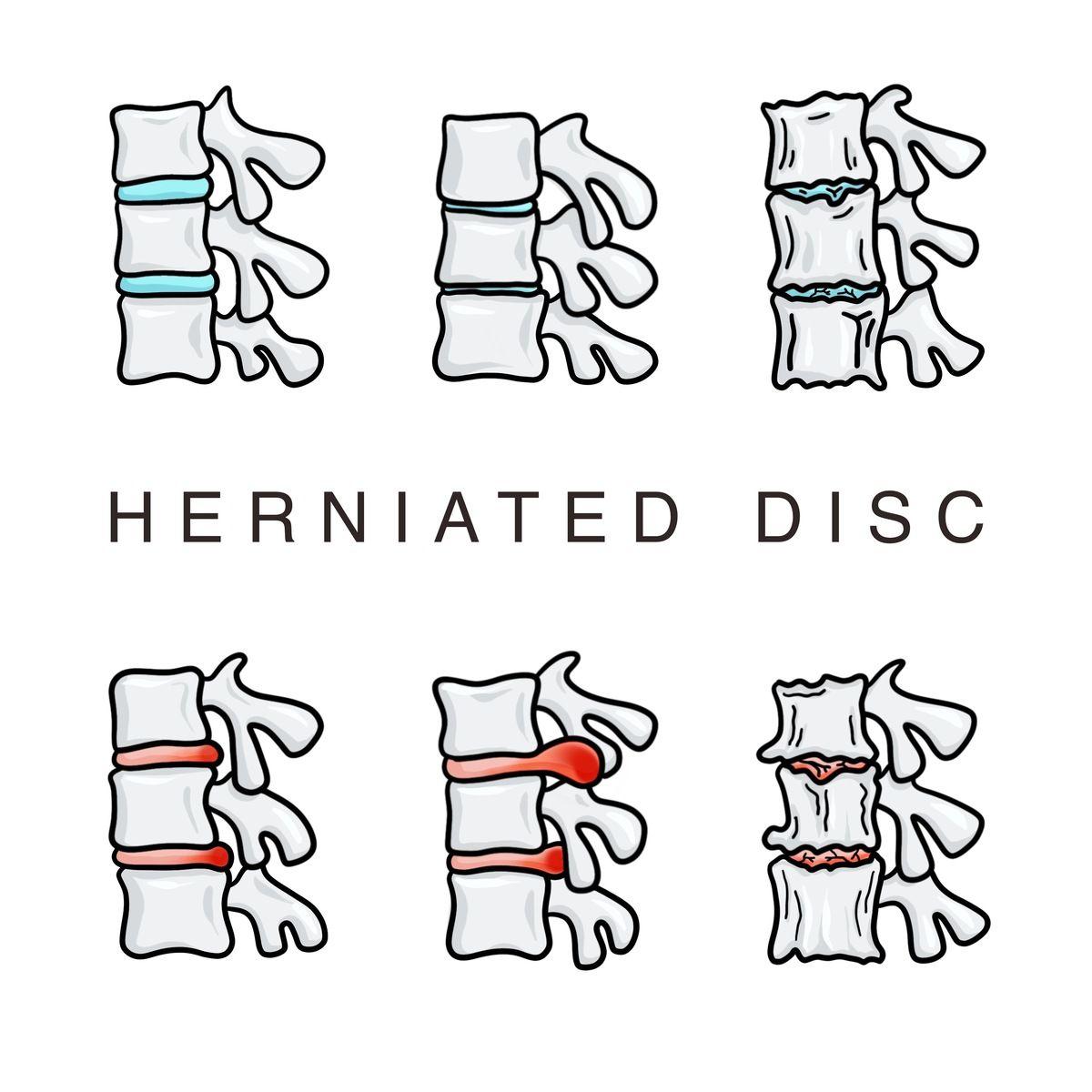 herniated disc