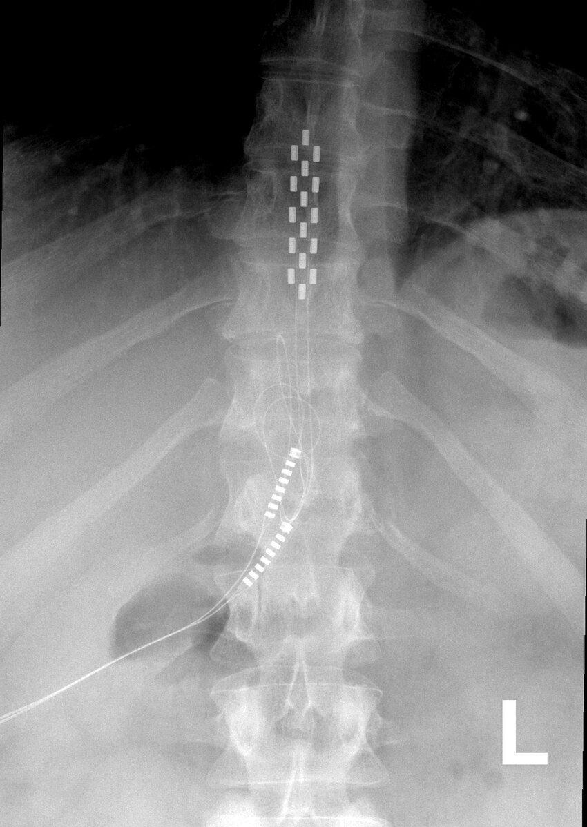 An x-ray showcasing the spinal cord stimulator. 
