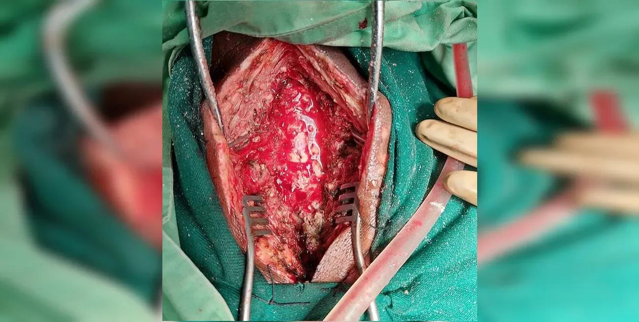 Showcasing highly invasive nature of laminectomy through the large skin incision made on the patient's lower back under surgery