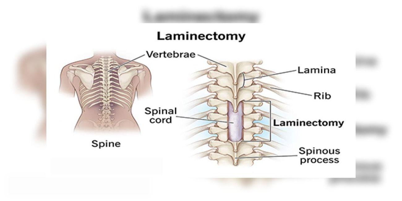 Diagram of human vertebrae with a demonstration of laminectomy surgery.