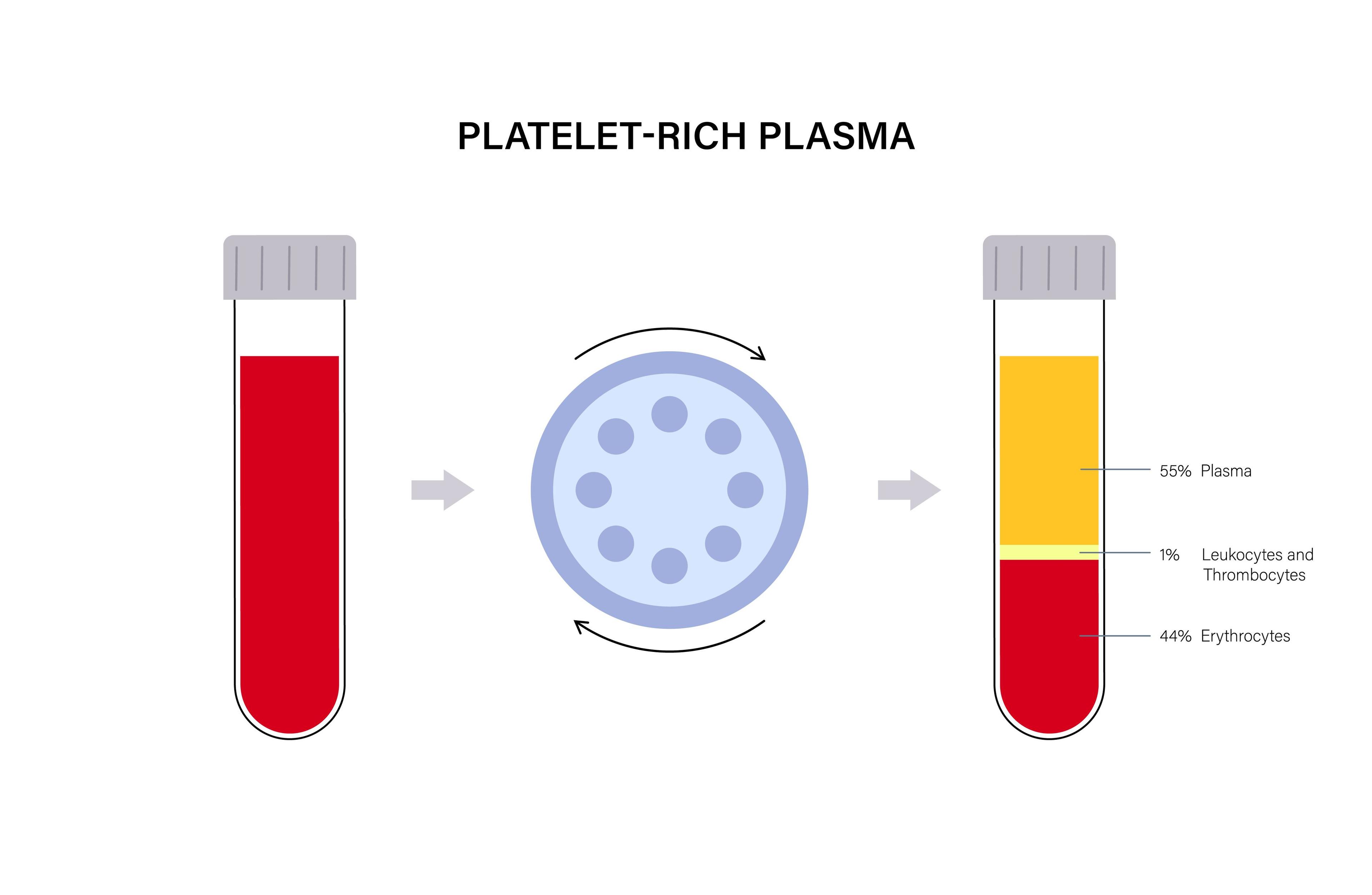 A picture showcasing extraction of platelet-rich-plasma for a PRP therapy.