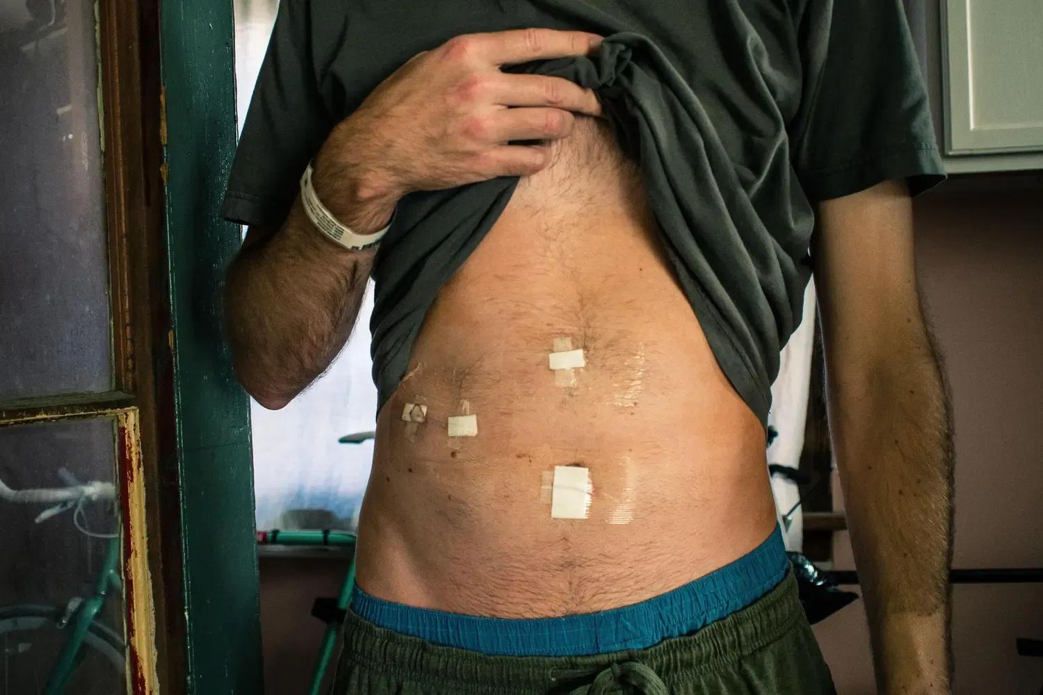 Man lifting shirt to show abdomen with surgical scars and bandages.