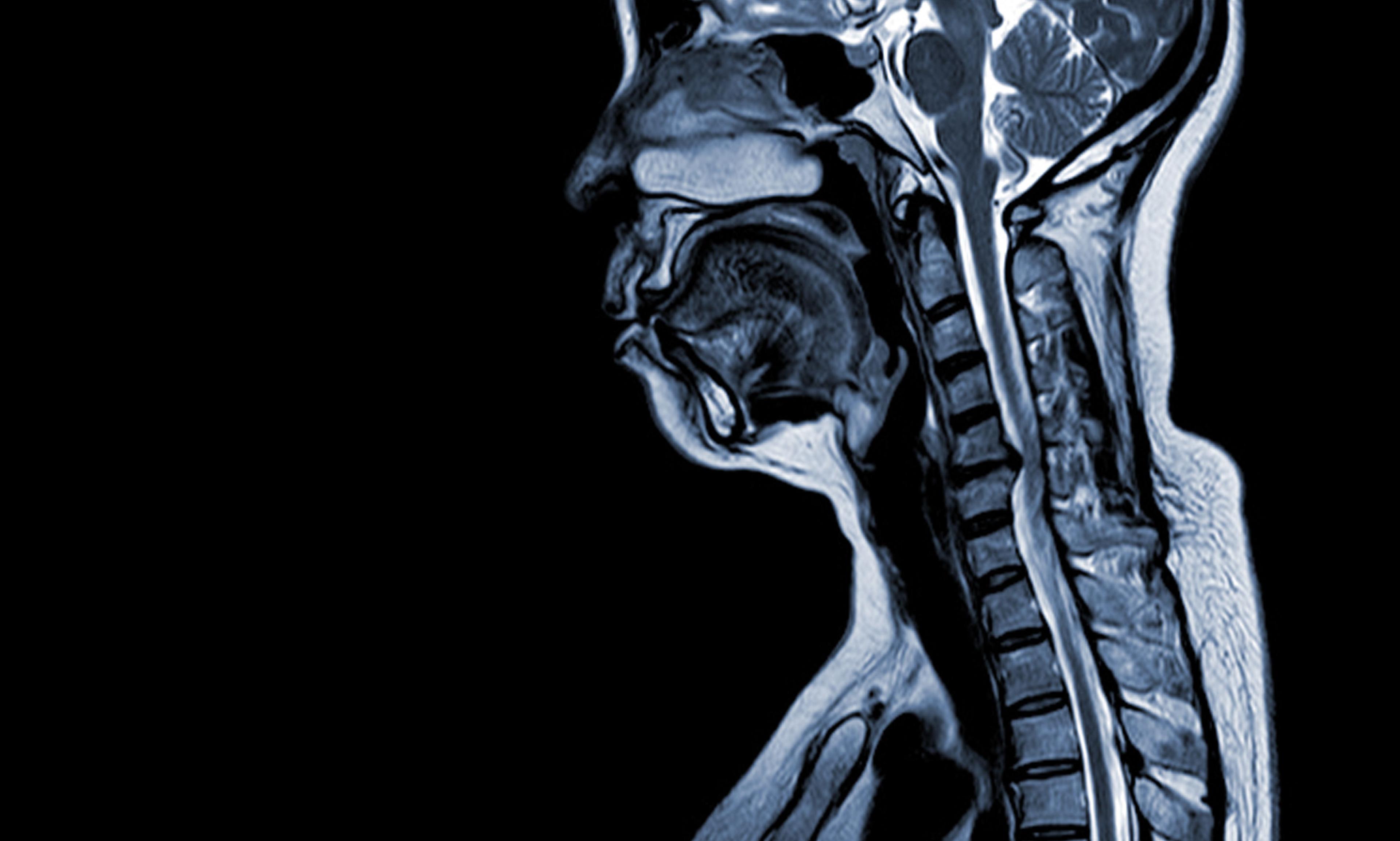 MRI image showing a C5-C6 disc herniation in the cervical spine.