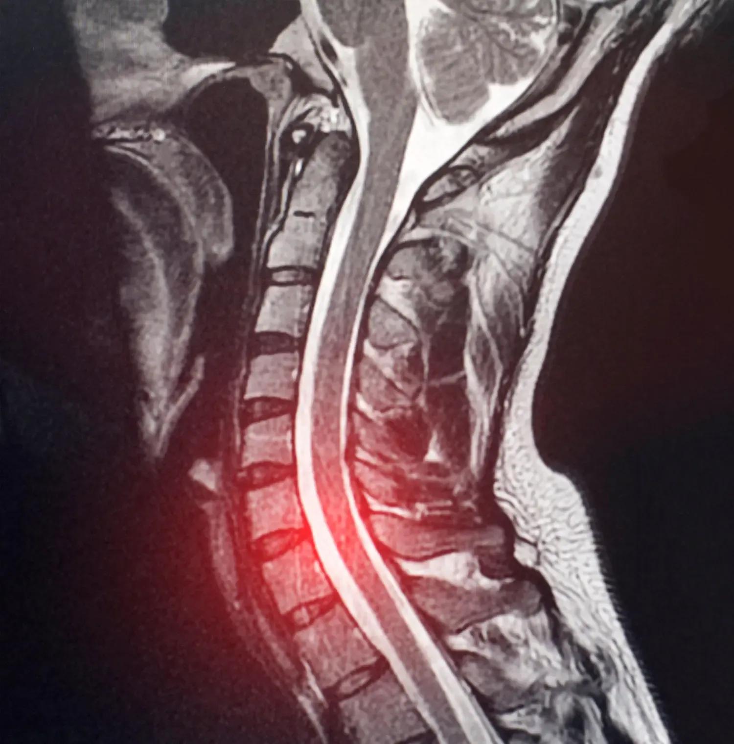 MRI scan showing C6-C7 disc herniation.