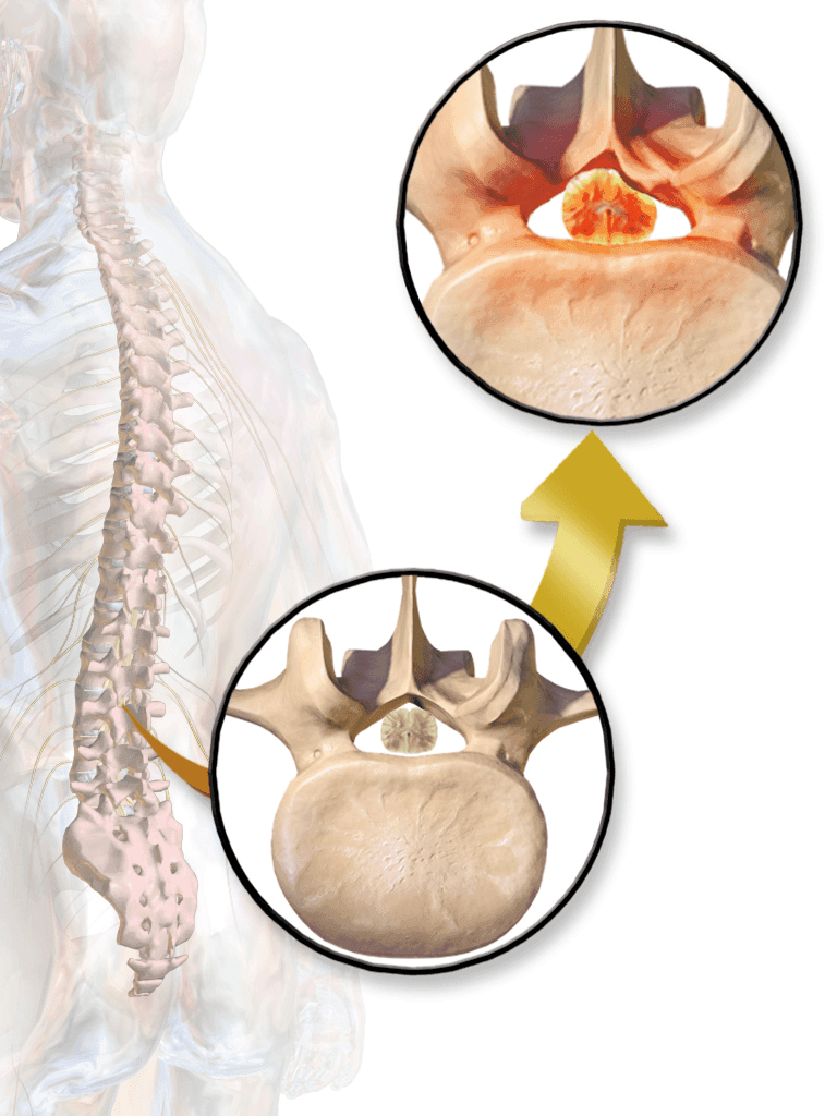 Illustration of spinal column and close-ups of vertebral canal