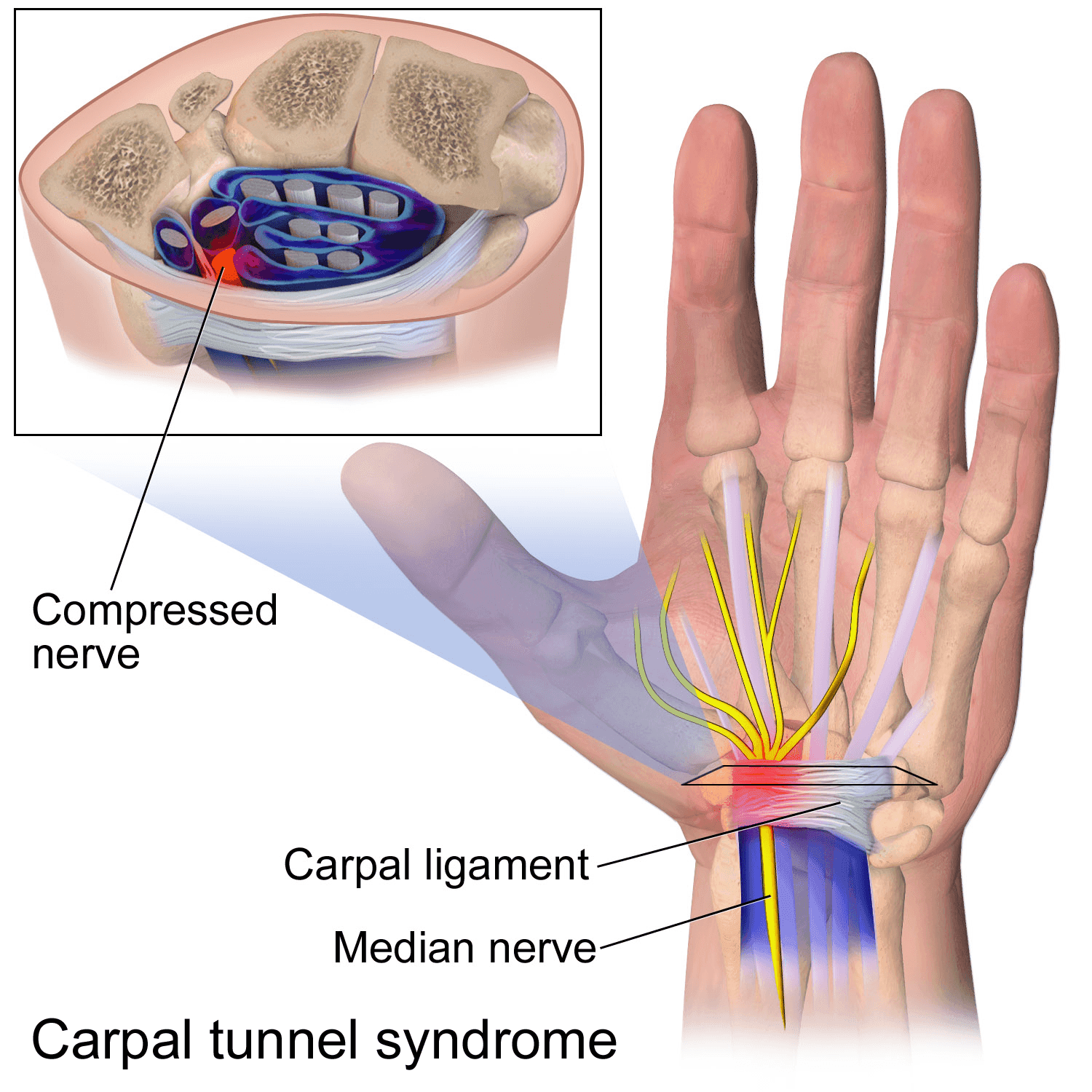 Illustration showing Carpal Tunnel Syndrome with cross-section of wrist.