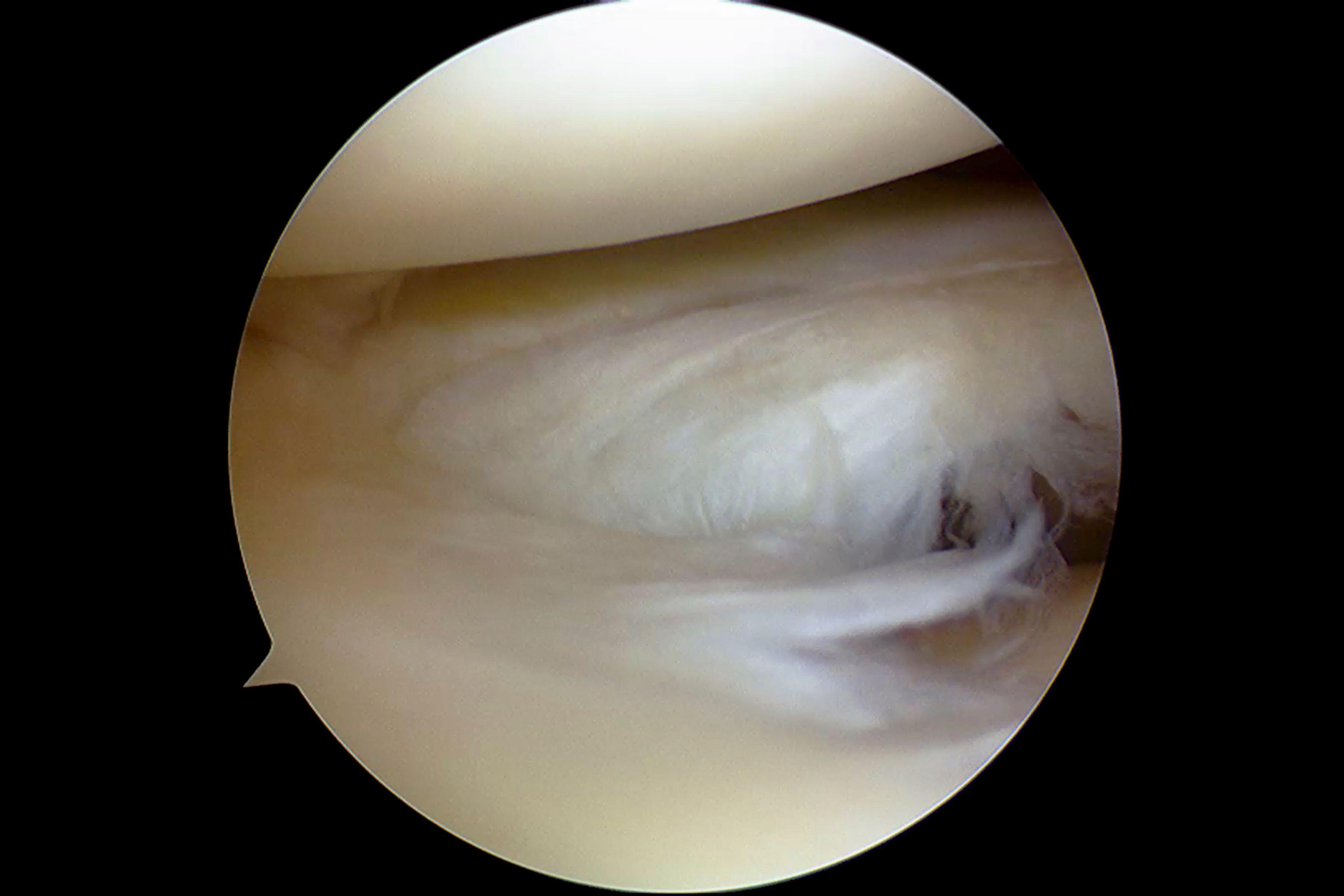 Endoscopic view of a torn disc.