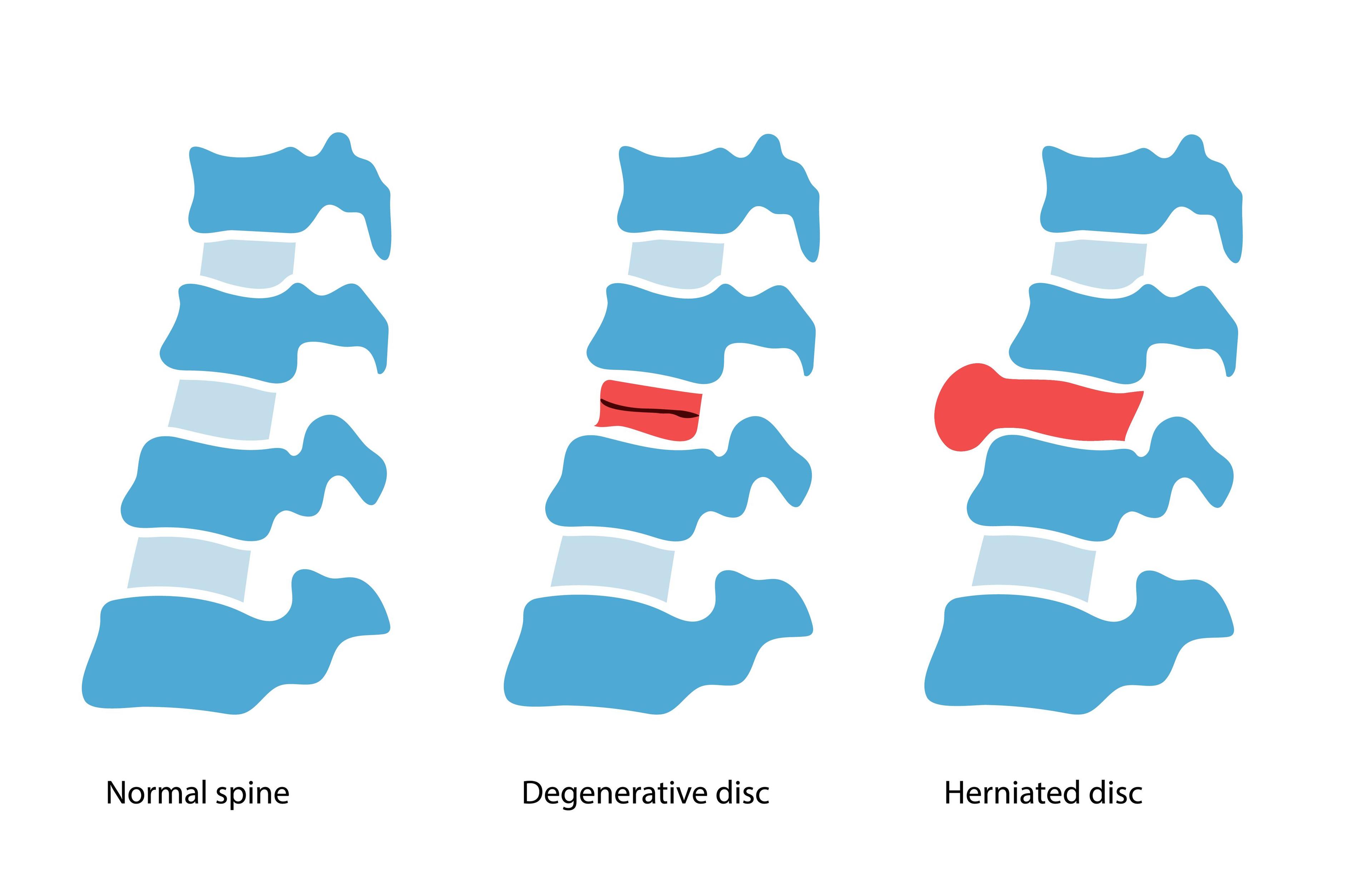 Illustration comparing normal, degenerative, and herniated spinal discs.