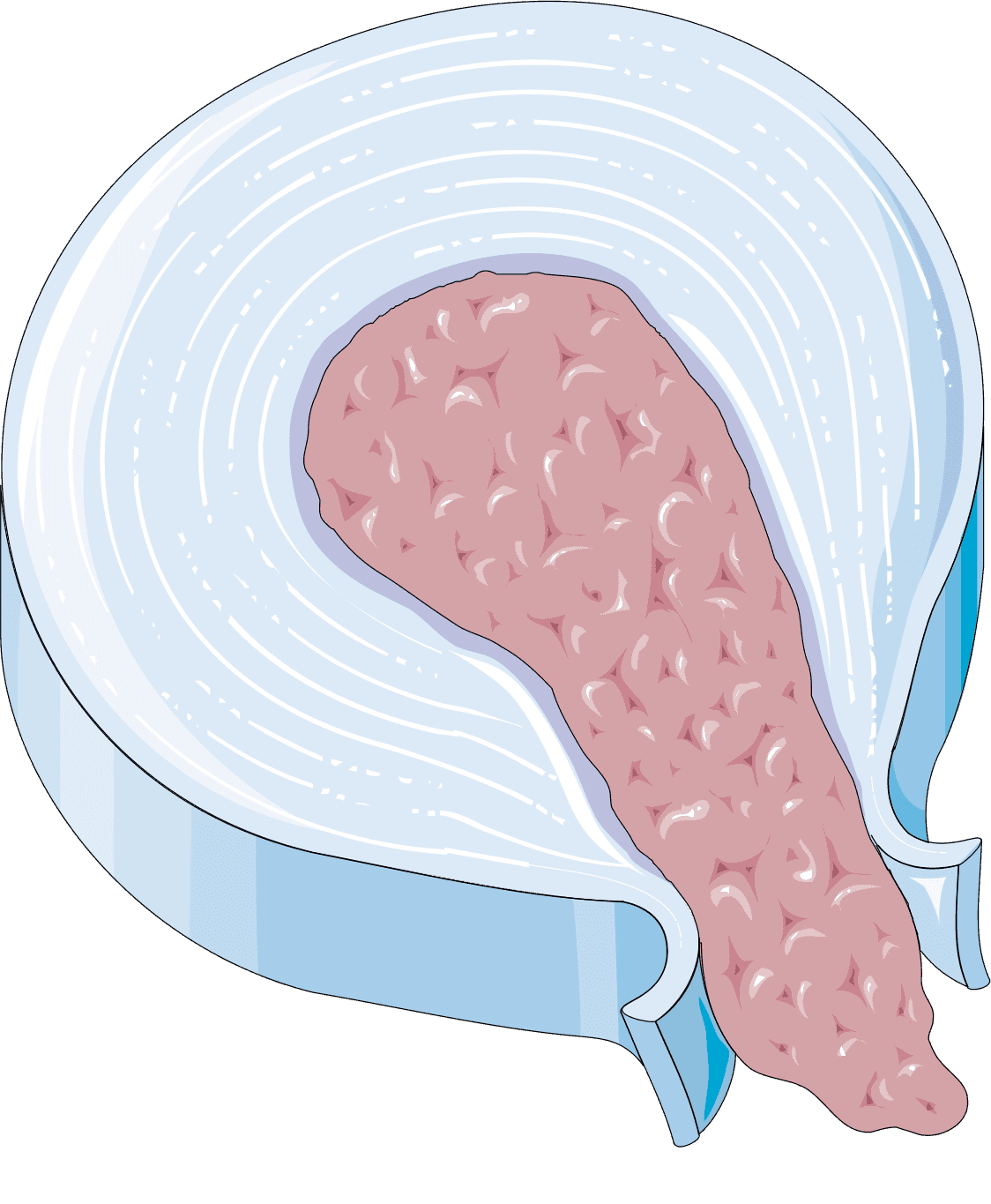 Illustration of a disc extrusion in the spine, showing protruding inner material.