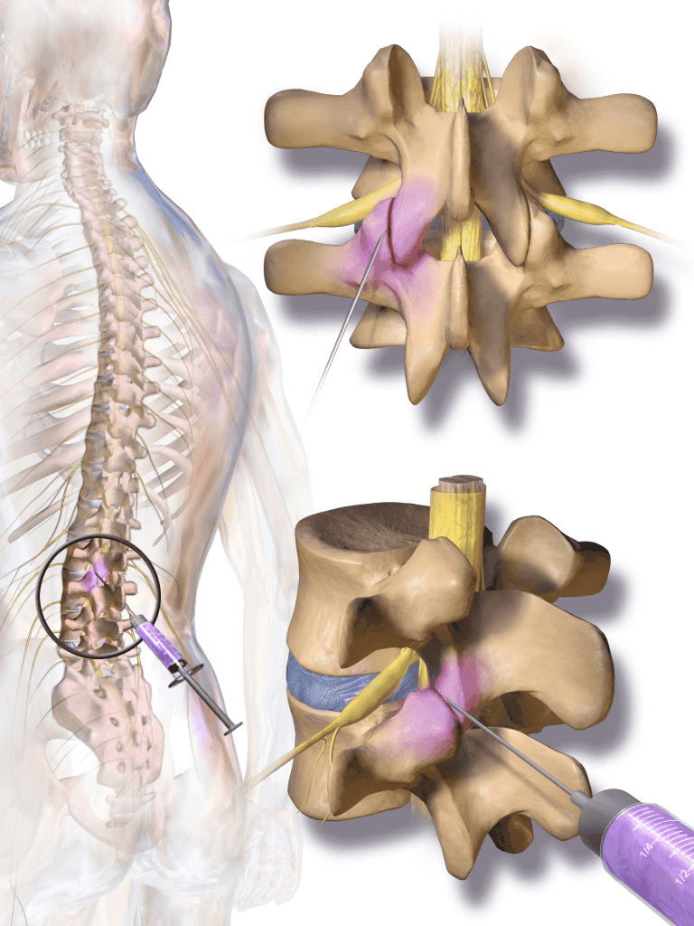 Medical illustration of facet syndrome in the spine