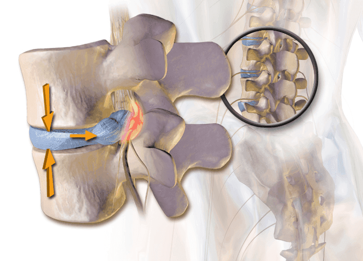An animation showcasing foraminal stenosis of the spine.