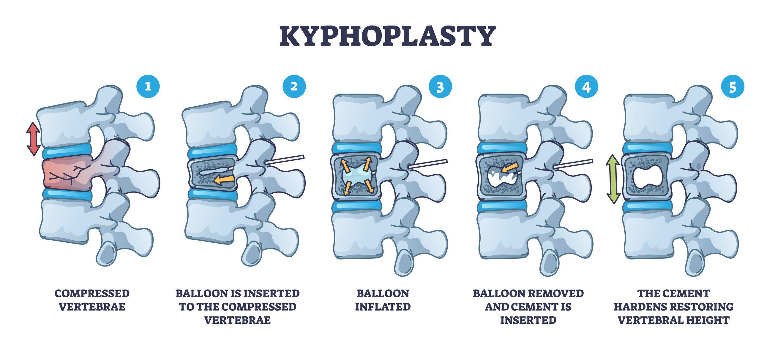 Illustration of kyphoplasty, a spinal fracture treatment through steps 1-5.