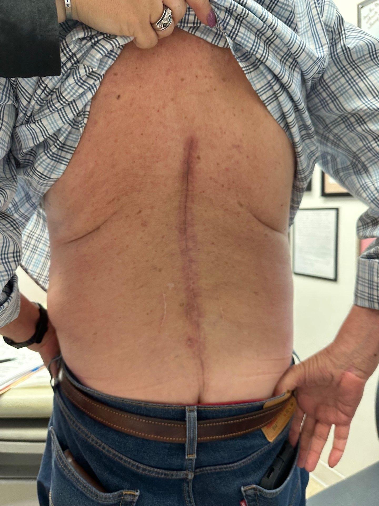 Patient with laminectomy scar starting at shoulders to the bottom of the torso