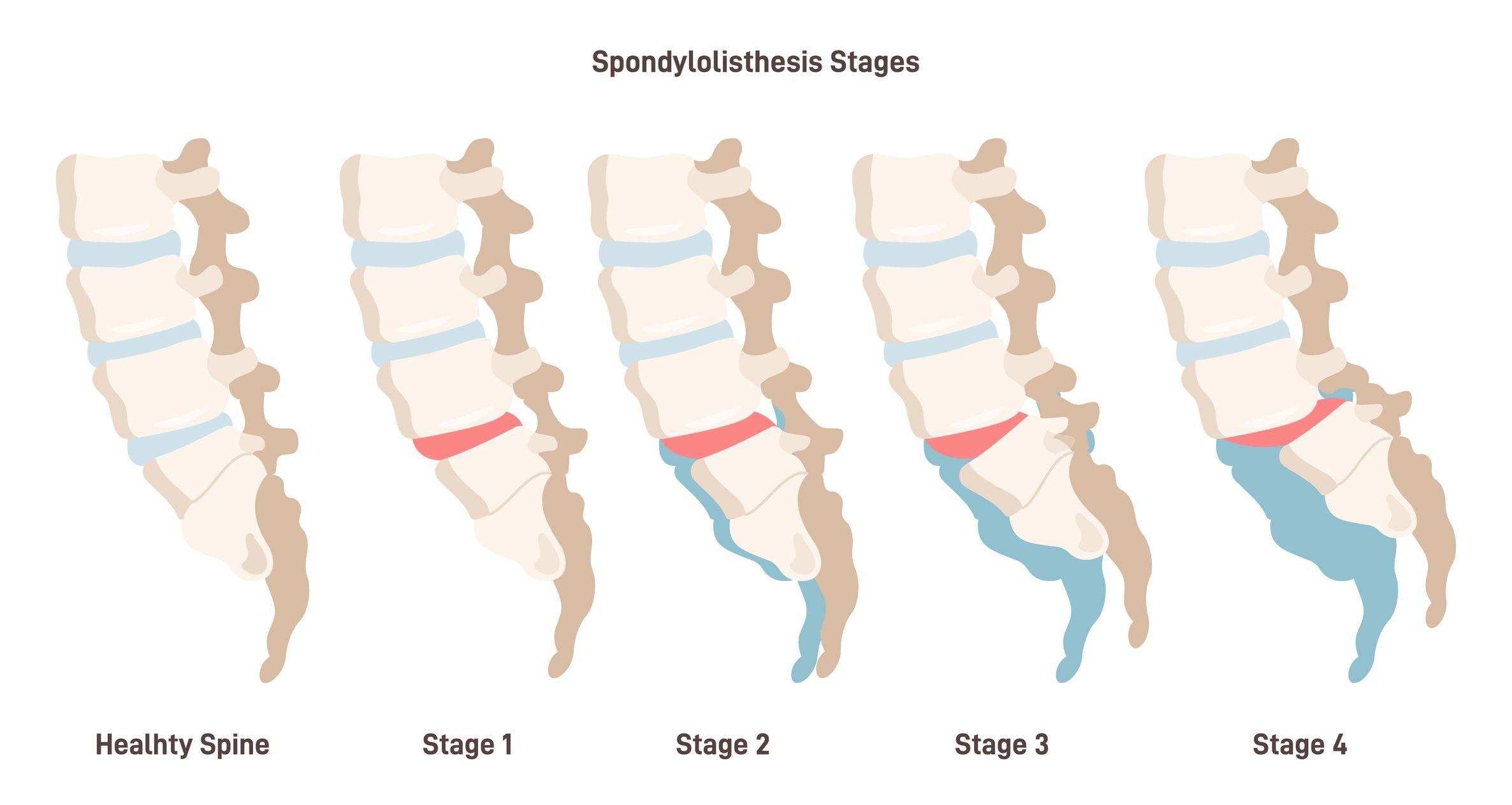 Diagram showing five stages of spondylolisthesis from healthy to stage 4.