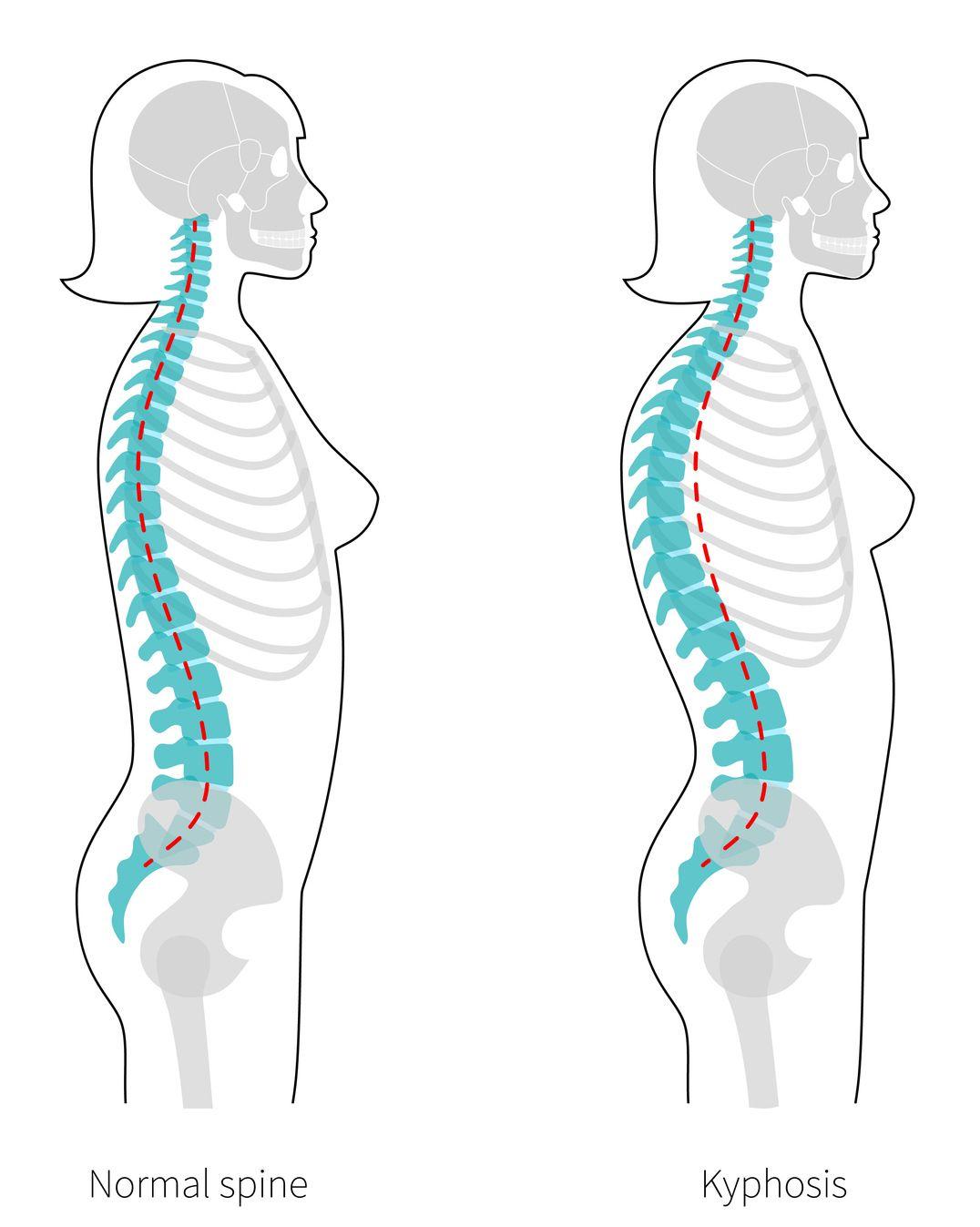 Illustration comparing a normal spine to one with kyphosis.