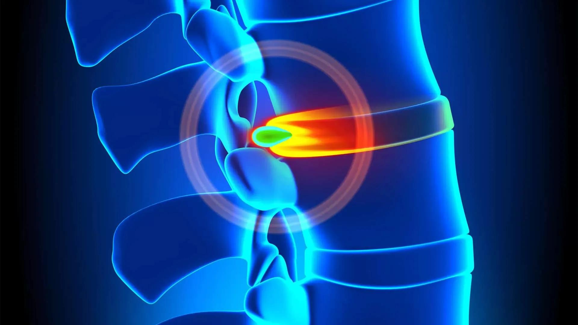Digital illustration of a human spine with a highlighted ruptured disc in orange.