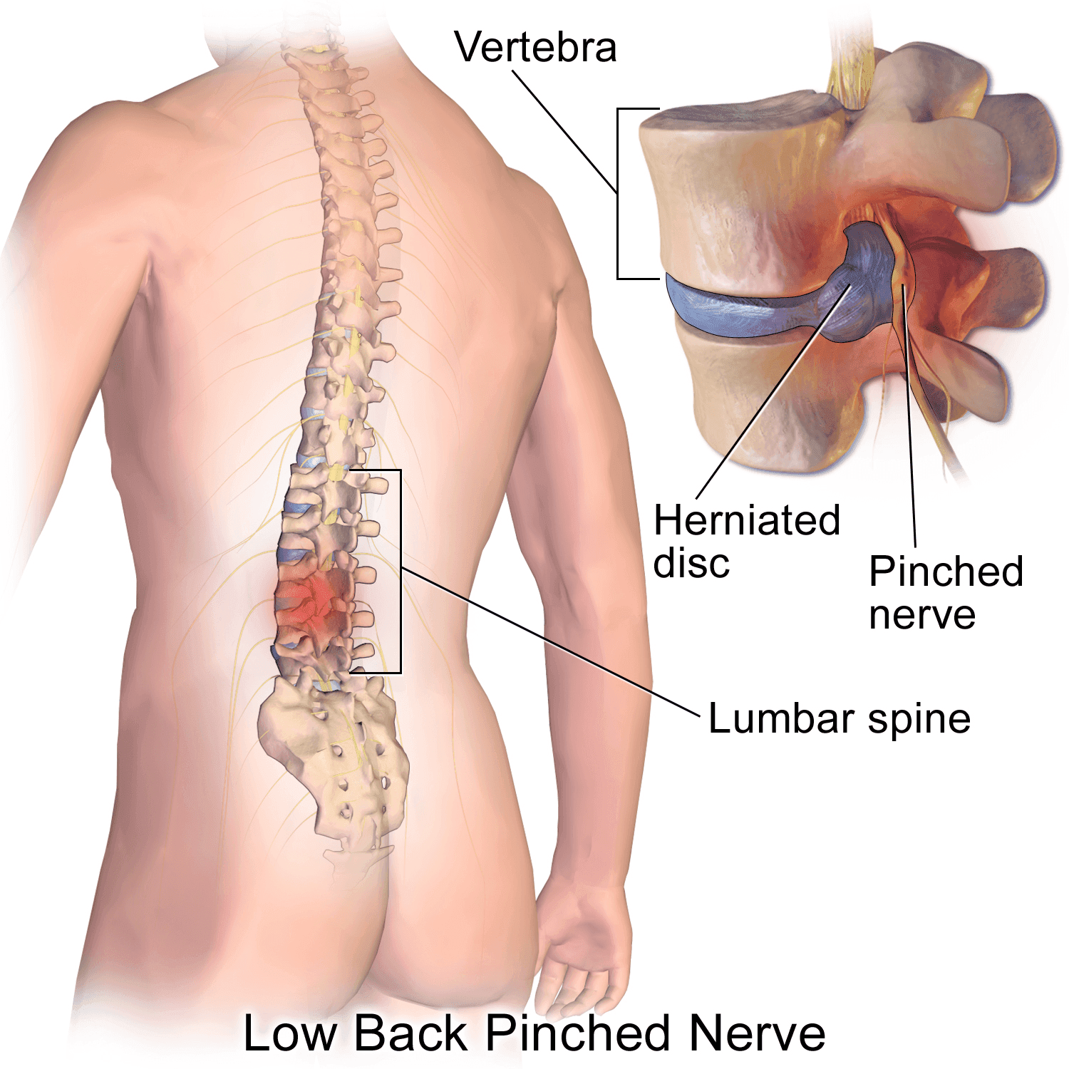 Diagram of a lower back showing a pinched nerve due to herniated disc.
