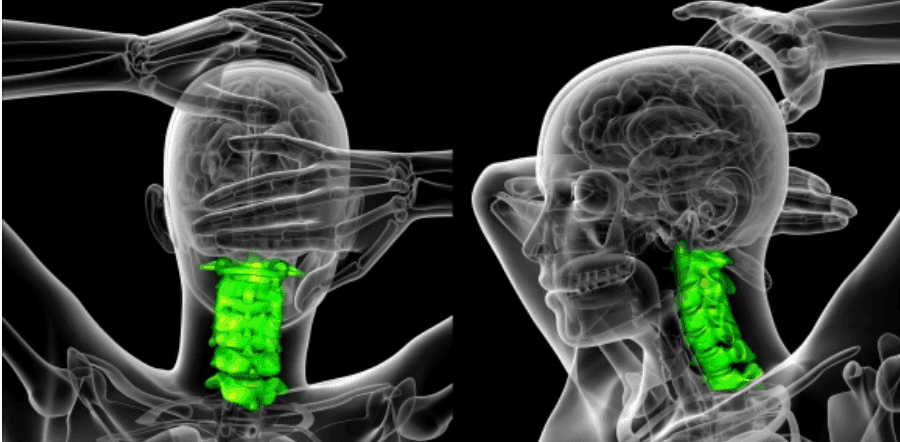 X-ray style image of two human figures showing highlighted green cervical vertebrae.