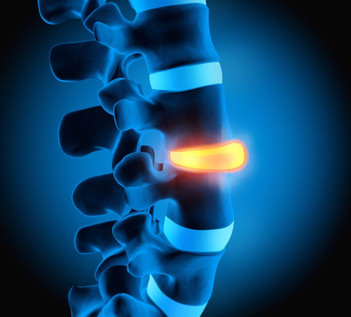 degenerative disc disease