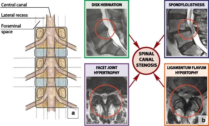 Diagram showcasing facet hypertrophy along with other conditions like Disc herniation, spondylolisthesis and ligamentum flavum hypertrophy.
