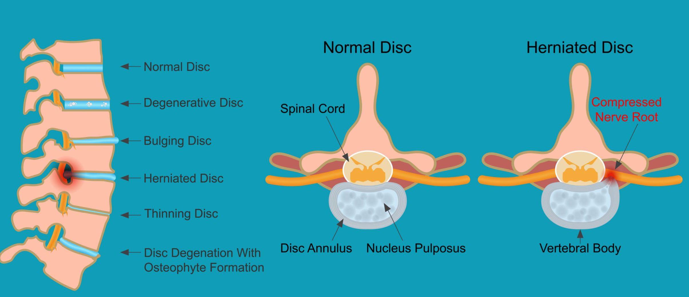 A picture showcasing a normal disc vs herniated disc.