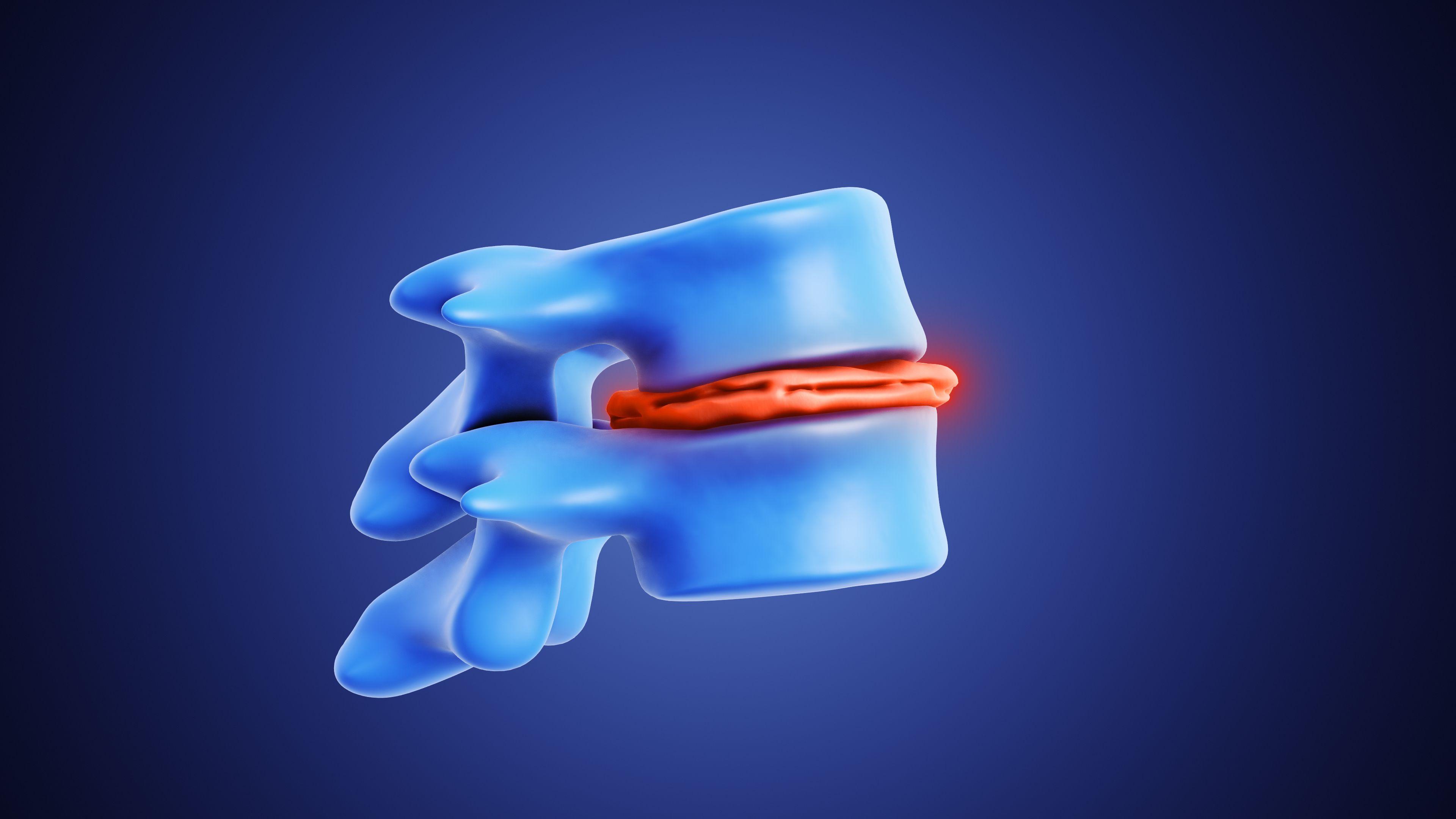 C7-T1 Bulging Disc Symptoms: 4 Key Signs