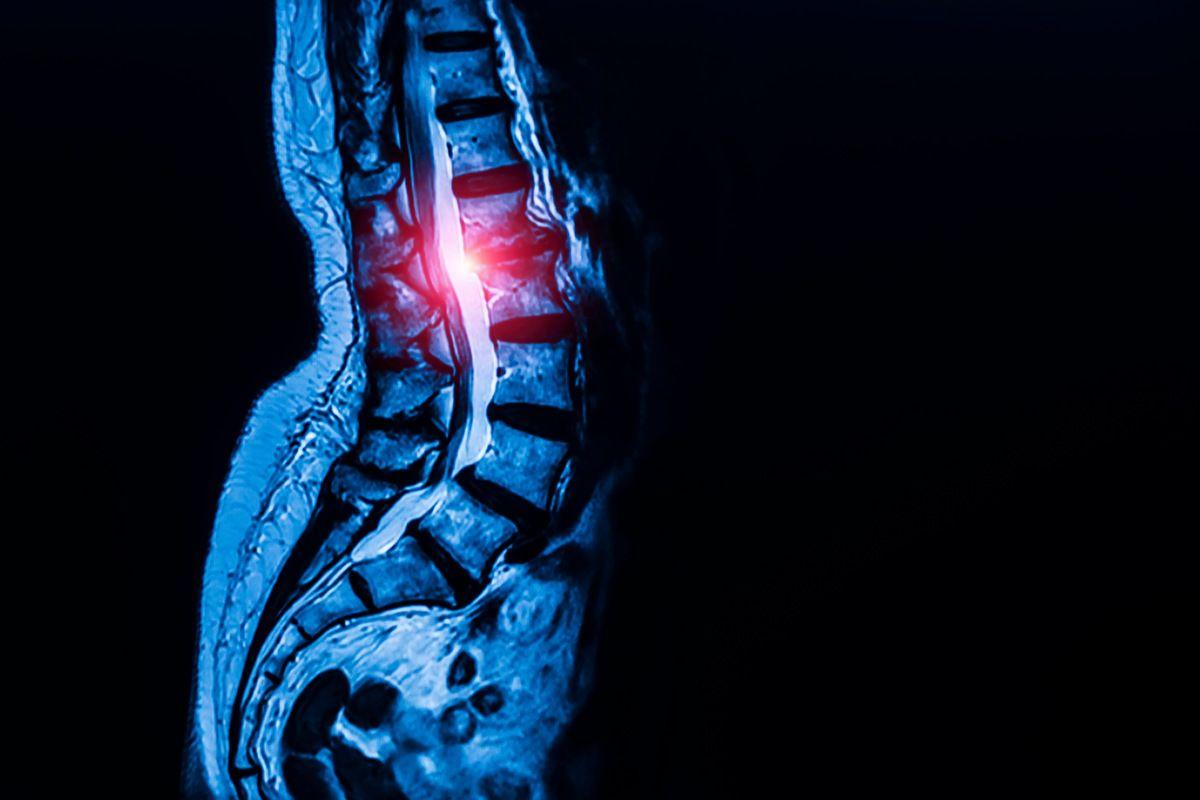 multilevel degenerative disc disease