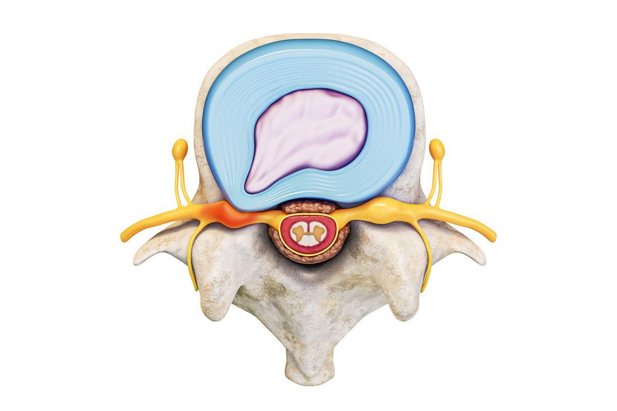 t6-t7 herniated disc symptoms