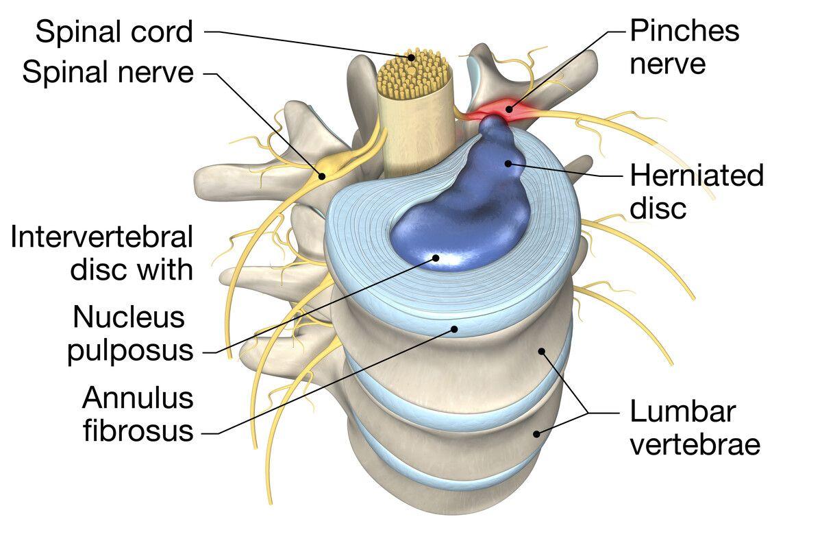 what is a herniated disc