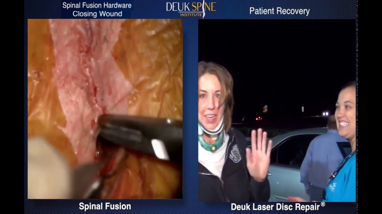 Cervical Deuk Laser Disc Repair vs. Anterior Cervical Discectomy & Fusion