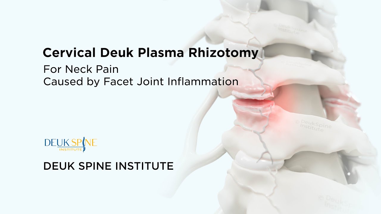 Cervical Deuk Plasma Rhizotomy (DPR) for Facetogenic Neck Pain