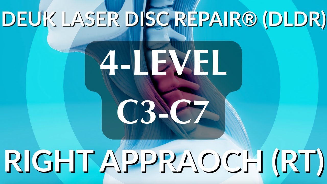 4-LEVEL CERVICAL C3-C4, C4-C5, C5-C6, C6-C7 - LIVE - Laser Spine Surgery