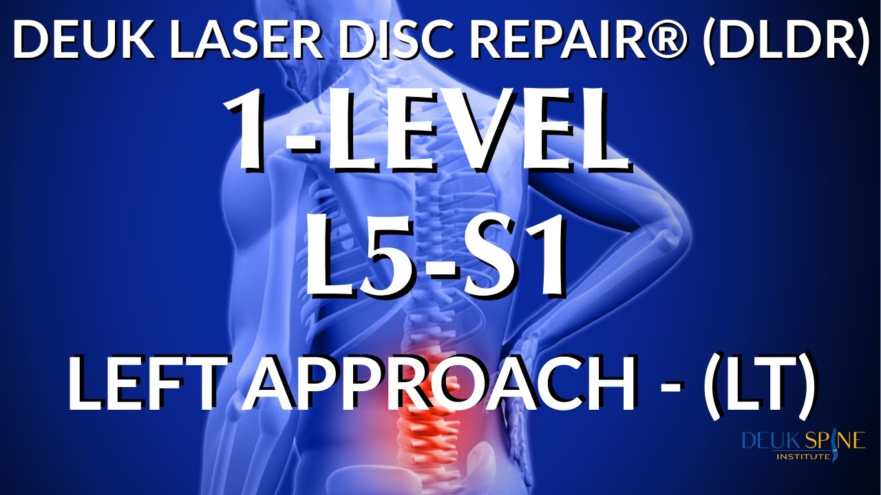 LOWER BACK PAIN, L5-S1 HERNIATED DISC - LIVE - Laser Spine Surgery