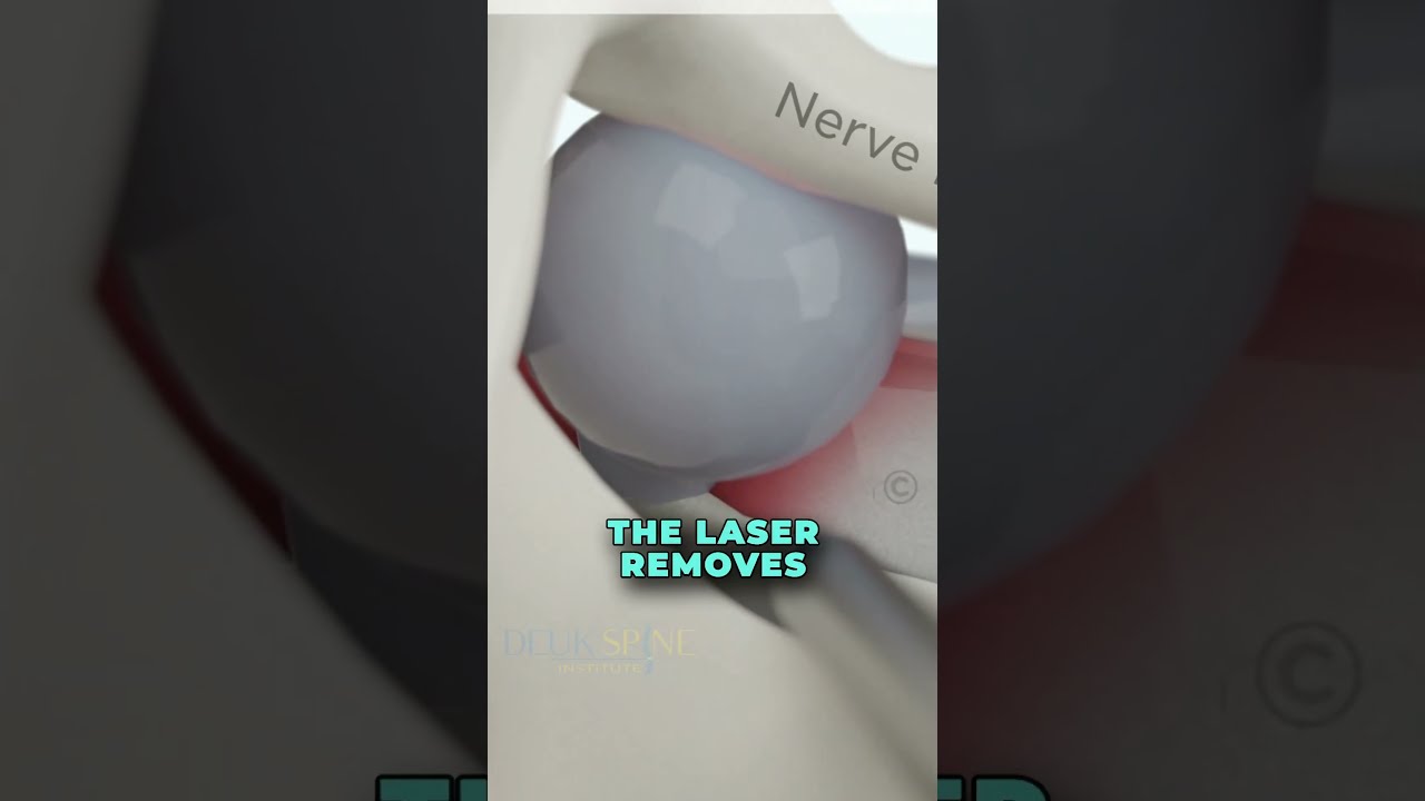 How To CURE Discogenic Lower Back Pain w/ the Deuk Laser Disc Repair® - (3D Animation)
