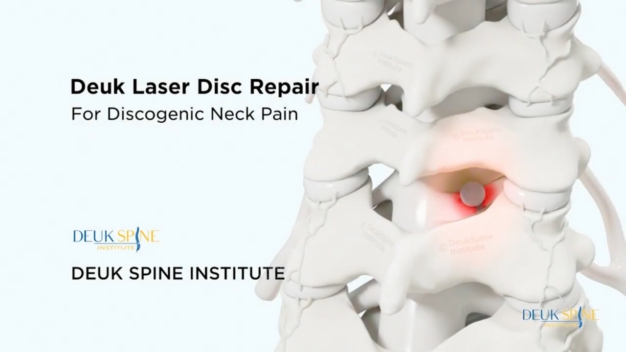 How To CURE Discogenic Neck Pain with the Deuk Laser Disc Repair®