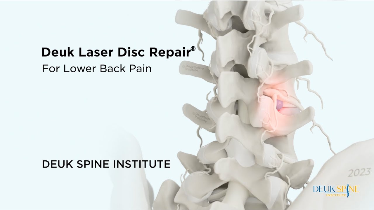 How to CURE Discogenic Lower Back Pain with the Deuk Laser Disc Repair®
