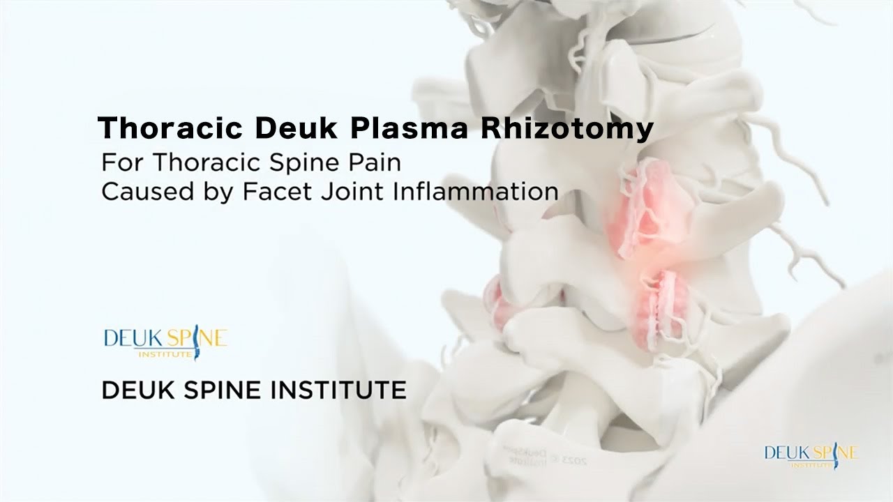 How To CURE Facetogenic Thoracic Back Pain w/ the Deuk Plasma Rhizotomy (DPR) - (3D Animation)