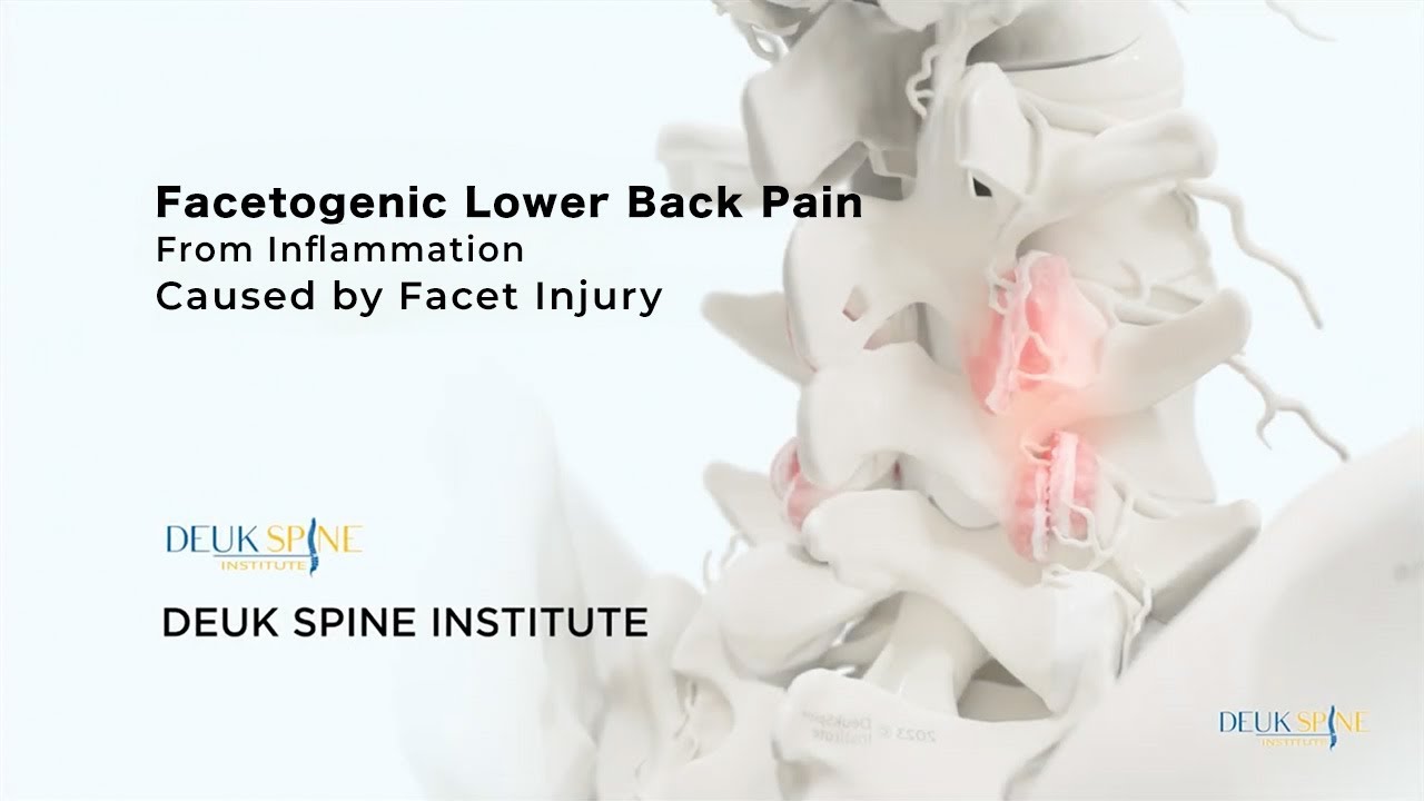 Facetogenic Lower Back Pain - (3D Animation)