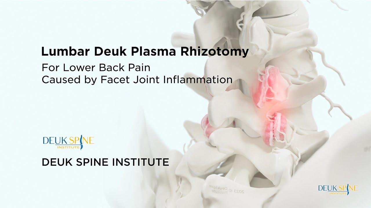 Lumbar Deuk Plasma Rhizotomy (DPR) for Facetogenic Back Pain - (3D Animation)