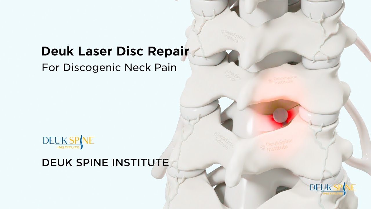 Cervical Deuk Laser Disc Repair (DLDR) for Discogenic Neck Pain - (3D Animation)