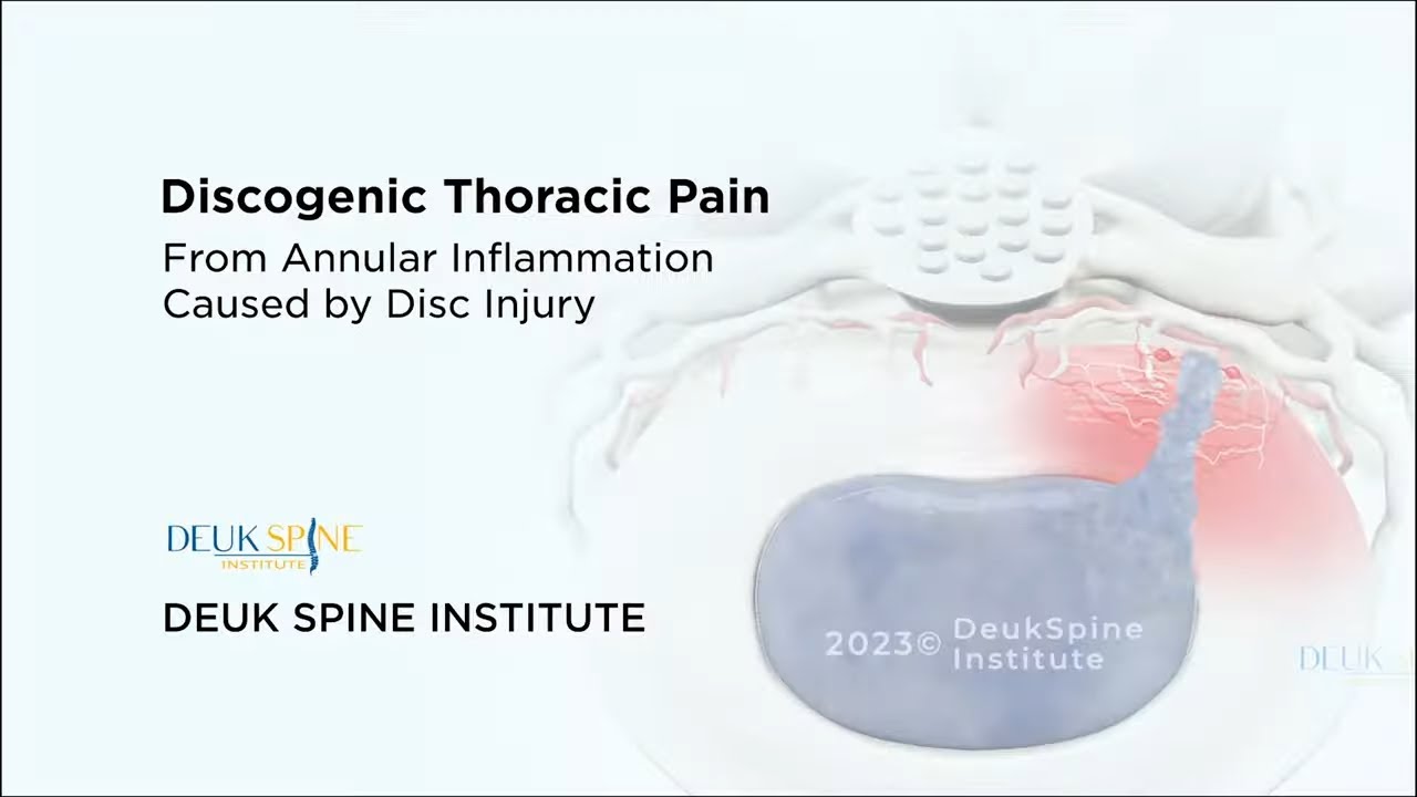 Discogenic Thoracic Back Pain  - (3D Animation)
